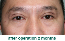 plastic-surgery-blepharoplasty